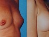 2a-breast-enlargement